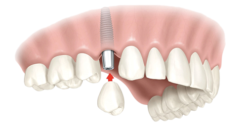 Single Dental Implants Lancaster